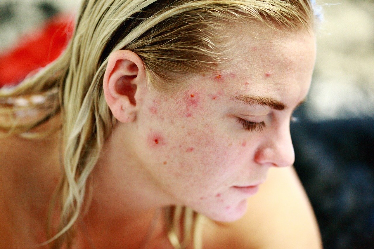 How Does CBD Help With Acne? Benefits, How To Apply And Wellbeing